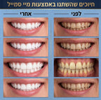 מארז ההלבנה הרשמי | MySmile PRO™